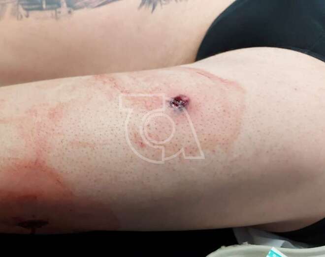 Imagen del orificio que originó el impacto de la bala en el muslo del agente/TA.